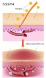 Secrets To Curing Eczema Naturally